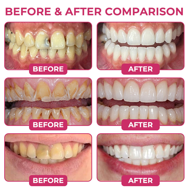 Tervence® Natural Enamel Restoration Gel for Cavity Repair