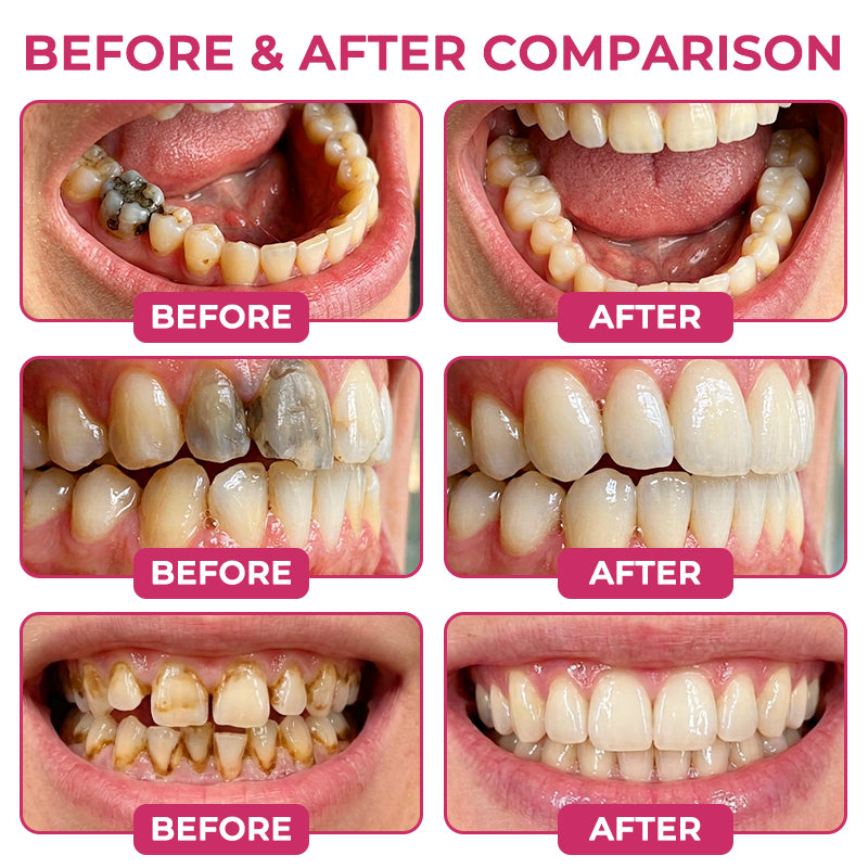 Tervence® Natural Enamel Restoration Gel for Cavity Repair